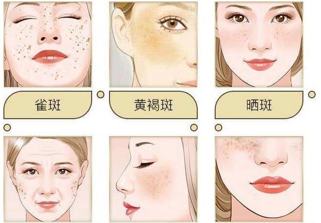 美容院祛斑真的能去掉嗎?會反彈嗎？