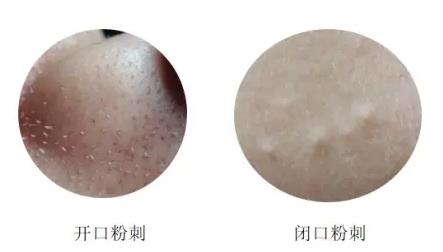 黑頭粉刺